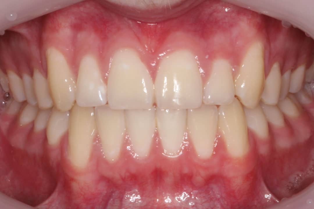 Upper & lower braces