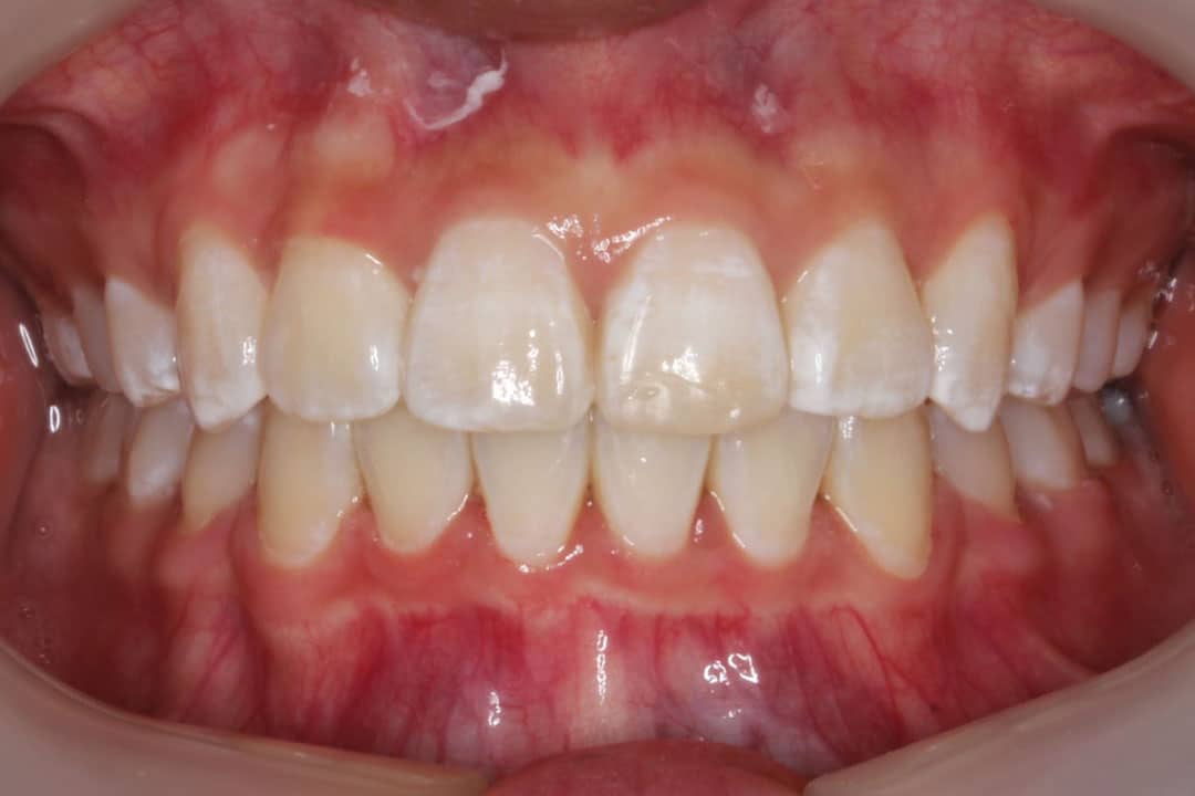Upper & lower braces