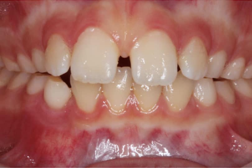 Junction Orthodontics Before 2
