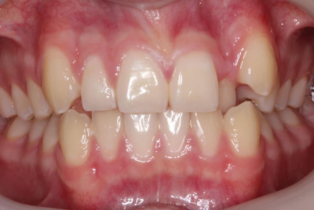 Crowding with the upper dental midline shifted to the side