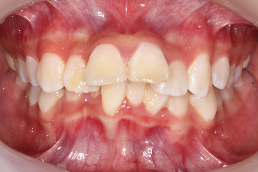 Severe crowding with protruded (flared) upper incisors