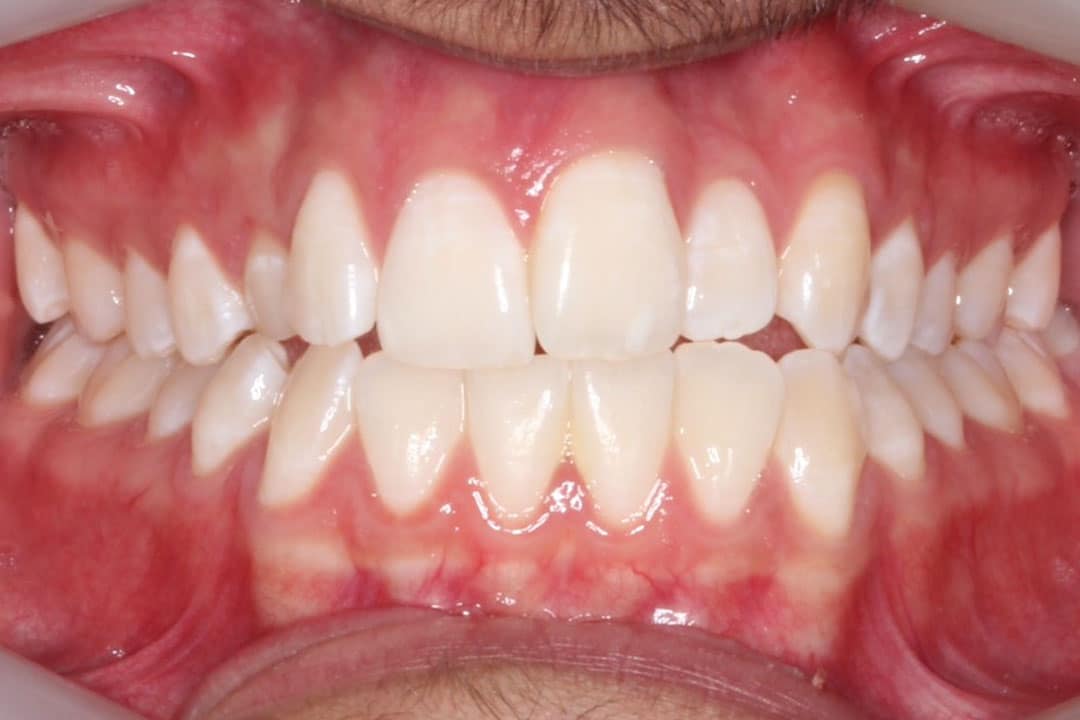 Crowding, narrow upper arch with an impacted (wayward) upper right adult canine